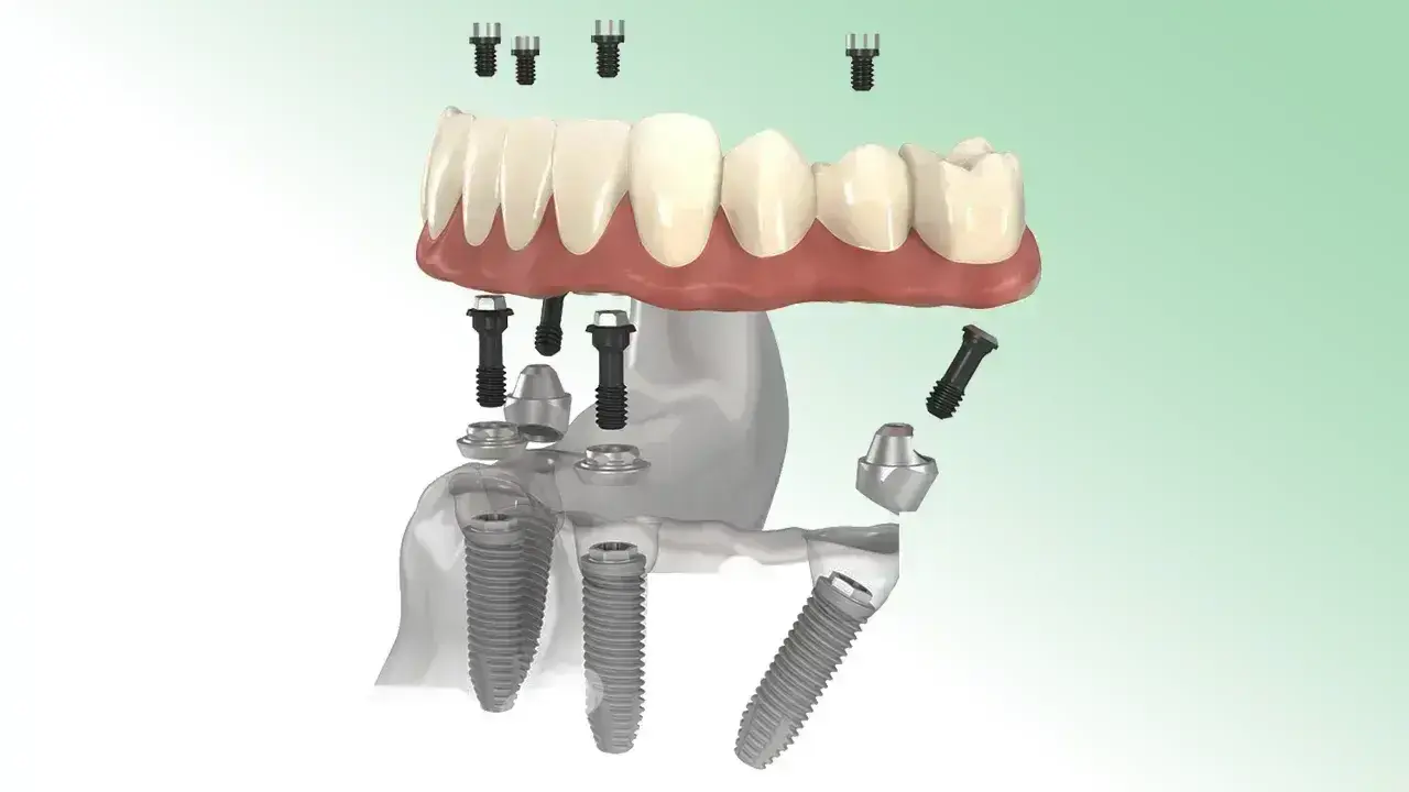 ALL-ON-4 DENTAL IMPLANT